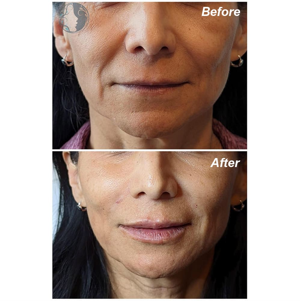 BOTOX before & after | Ethereal Aesthetics