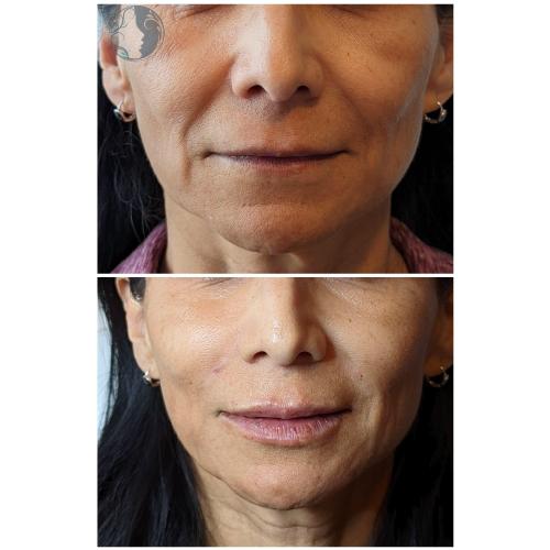 HYALURONIC ACID before & after | Ethereal Aesthetics