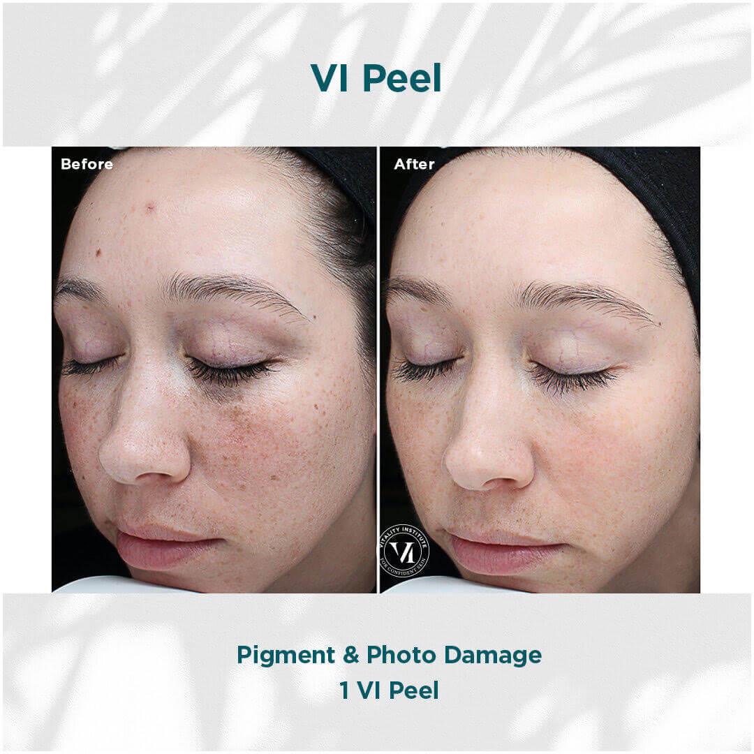 VI PEEL before & after | Ethereal Aesthetics